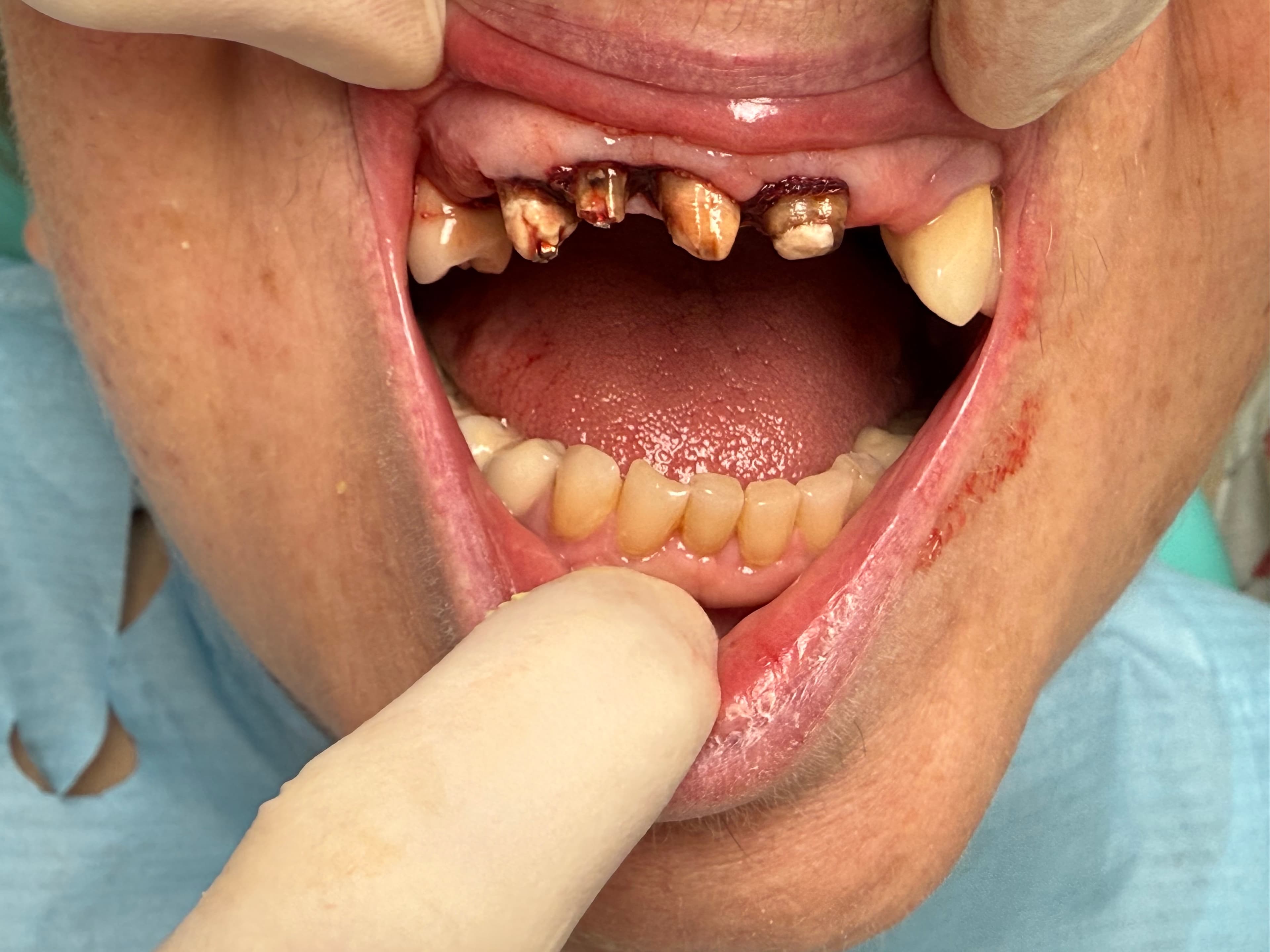 Teljes felső fogsor pótlás - frontal nézet - 1