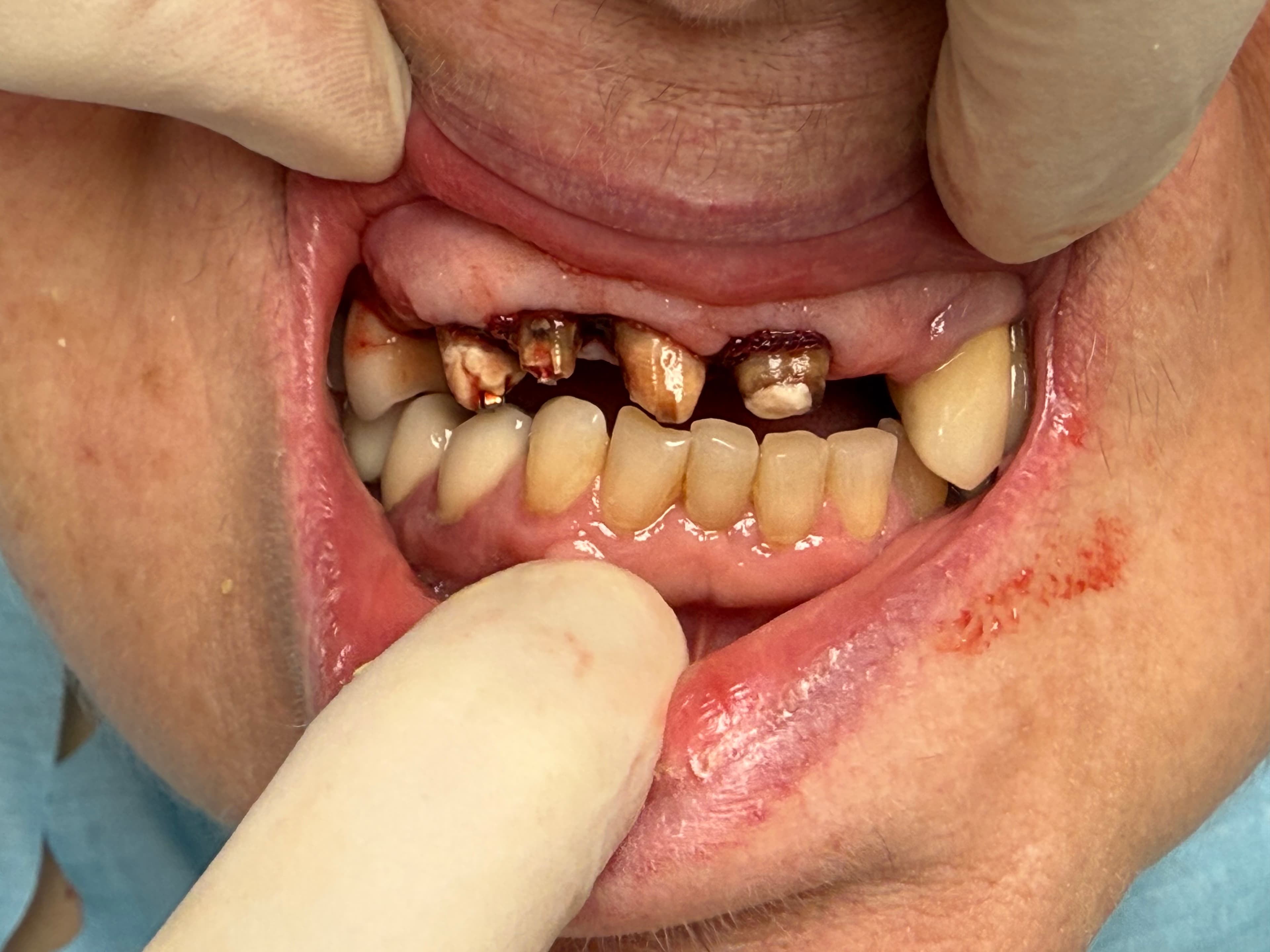 Teljes felső fogsor pótlás - részletes nézet - 1