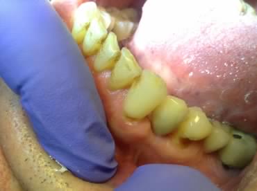 3-implantatum-utana_small